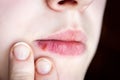 Girl\'s lips affected by herpes. Royalty Free Stock Photo