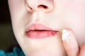 Girl\'s lips affected by herpes. Royalty Free Stock Photo