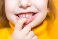 Girl shows her teeth-pathological bite, malocclusion, overbite. Pediatric dentistry and periodontics, bite correction. Health and