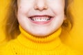 Girl shows her teeth-pathological bite, malocclusion, overbite. Pediatric dentistry and periodontics, bite correction. Health and