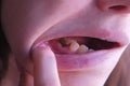 Girl shows pink tooth with caries and cured with use resorcinol-formalin paste.