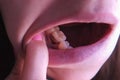 Girl shows pink tooth with caries and cured with use resorcinol-formalin paste.