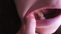 Girl shows pink tooth with caries and cured with use resorcinol-formalin paste.