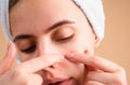 Girl squeezing pimples on face. Acne blemish spots skin on young woman. Spot scar acne, freckles, and melasma Royalty Free Stock Photo