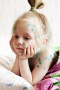 Girl suffers chickenpox