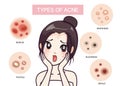 Girl and type of acne.