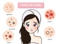 Girl and type of acne.