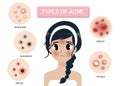 Girl and Types of acne.