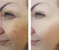 Girl wrinkles aging before and after the procedures