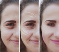 Girl wrinkles eyes before and after bloating therapy effect treatment procedures Royalty Free Stock Photo