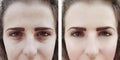 Girl wrinkles eyes before after procedures bags Royalty Free Stock Photo