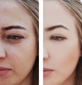 Girl wrinkles eyes before and after removal procedures, bags, bloating Royalty Free Stock Photo