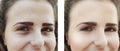 Girl wrinkles eyes before after procedures bags correction