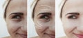 Girl wrinkles eyes before after lifting correction removal effect treatment procedures Royalty Free Stock Photo