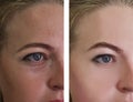 Girl wrinkles eyes before and after treatments
