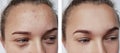 Girl wrinkles eyes before and after treatments skin removal bags