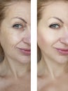 Girl wrinkles before and after lifting therapy treatments Royalty Free Stock Photo