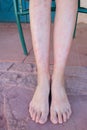 Girl& x27;s legs bitten by mosquitoes, close-up. Woman scratching her feet bitten by insects.