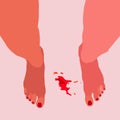 Girl's legs, bloodstain. Menstruation theme, period. Feminine hygiene.