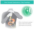 Give Yourself Gastrostomy Tube Feedings