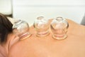 Glass cups sucked on back of young woman - closeup detail of cupping therapy, alternative medicine form Royalty Free Stock Photo