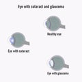 Glaucoma eye. Development of Glaucoma. The structure of the eye. Cataract. Eye vision disorder.
