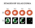 Glaucoma. The field of vision in glaucoma. Atrophy of the optic nerve. Infographics. Vector illustration Royalty Free Stock Photo