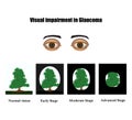 Glaucoma. The field of vision in glaucoma. Infographics. Vector illustration on background