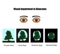 Glaucoma. The field of vision in glaucoma. Infographics. Vector illustration on background