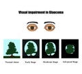 Glaucoma. The field of vision in glaucoma. Infographics. Vector