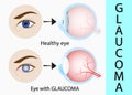 Glaucoma and healthy eye detailed structure.