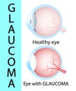 Glaucoma and healthy eye detailed structure.