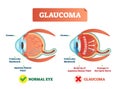 Vector illustration of glaucom. Cross section with damaged eye. Scheme with cornea, trabecular meshwork and aqueous humor fluid.