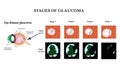 Glaucoma. The structure of the eye. The field of vision in glaucoma. Atrophy of the optic nerve. Infographics. Vector