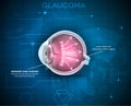 Glaucoma, vision disorder