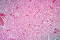 Glioma tumor with diseased tissue Royalty Free Stock Photo