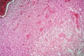 Glioma tumor with diseased tissue Royalty Free Stock Photo