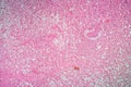 Glioma tumor with diseased tissue Royalty Free Stock Photo