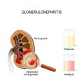 Glomerulonephritis glomerular nephritis. Human kidney, and clo Royalty Free Stock Photo