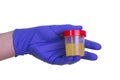 A gloved doctor hand with the urine container for medical urine test. A photo of urine specimen, medical analysis in the laborator