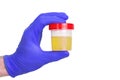 A gloved doctor hand with the urine container for medical urine test. A photo of urine specimen, medical analysis in the laborator