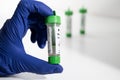 Gloved hand holding stool sample collection kit for parasite testing Royalty Free Stock Photo