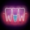 Glow Dentition with Implanted Tooth Royalty Free Stock Photo