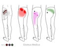 Gluteus medius: Myofascial trigger point and hip, outer thigh referred pain locations