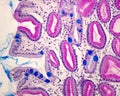 Intestinal metaplasia of gastric mucosa