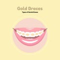 Gold Dental Braces.