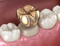 Golden crown molar tooth assembly process. Medically accurate 3D illustration of human teeth