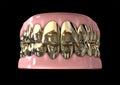 Golden Gangster Teeth And Gums Royalty Free Stock Photo