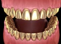 Golden teeth crowns over natural teeth. Medically accurate 3D illustration of human teeth