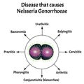 Gonococcus structure. Disease that causes Neisseria gonorrhoeae. Gonorrhea disease. Venereal disease. Sexually
